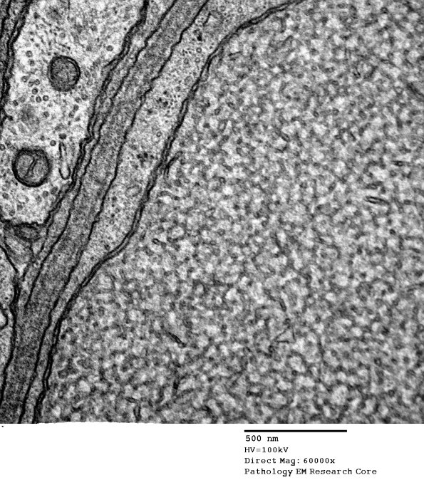 11G3 neuroaxonal dystrophy (Case 18) 34 (2) - Copy