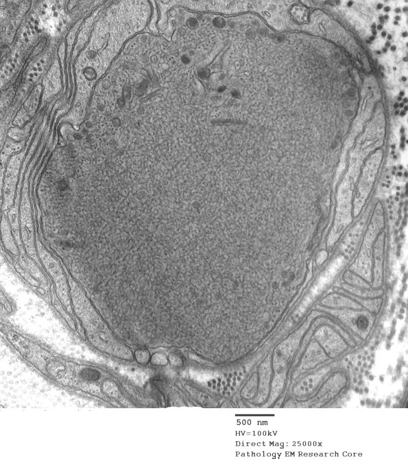 11H1 AD (Case 18) EM 0 - Copy