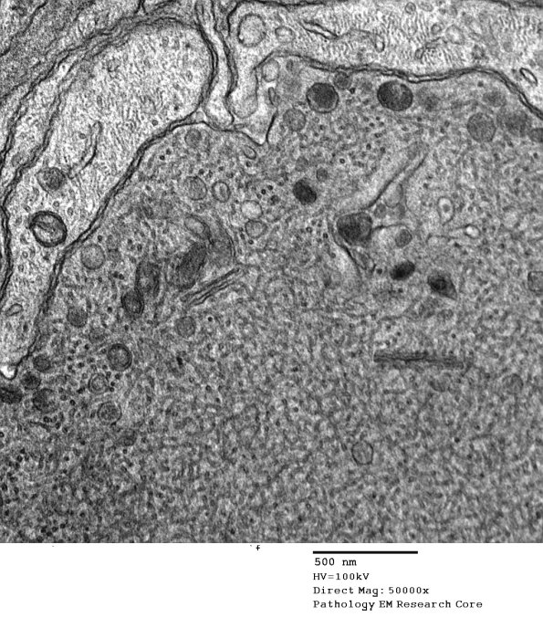11H2 AD (Case 18) EM 0 - Copy
