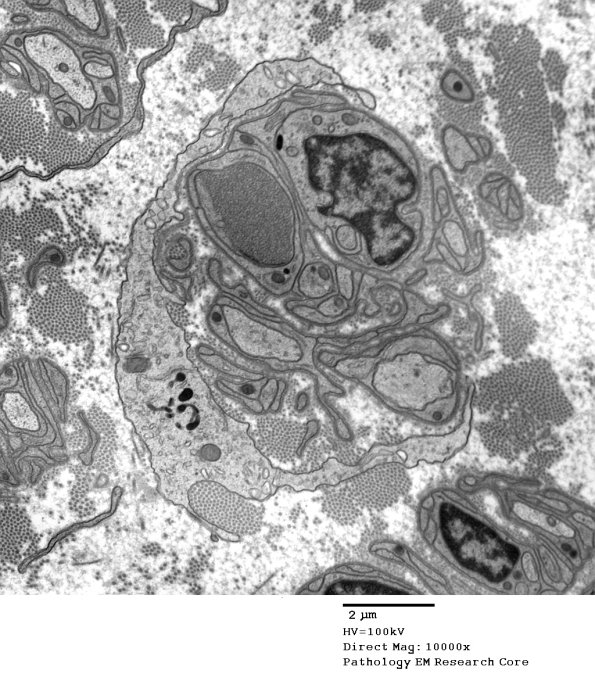 11J1 AD (Case 18)  EM 3 - Copy