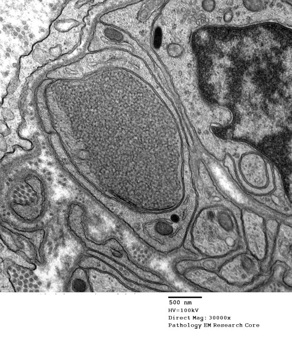 11J2 AD (Case 18) EM 2 - Copy