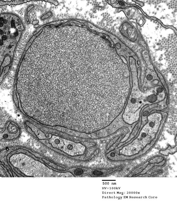 11K1 AD (Case 18) EM 1 - Copy