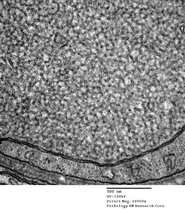 11K2 AD (Case 18) EM 1 - Copy
