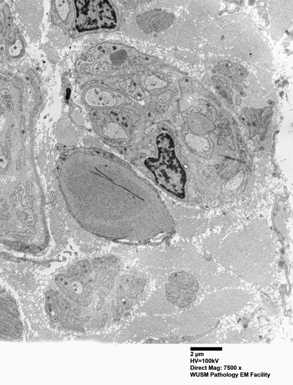 11L1 W24-3671 Anders G (Case 22) Sural_075 - Copy