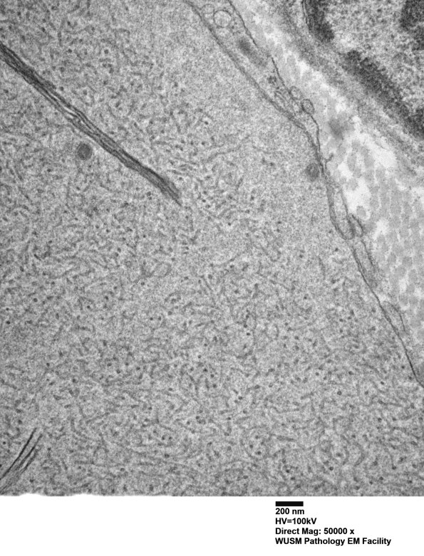 11L2 W24-3671 Anders G (Case 22) Sural_068 - Copy