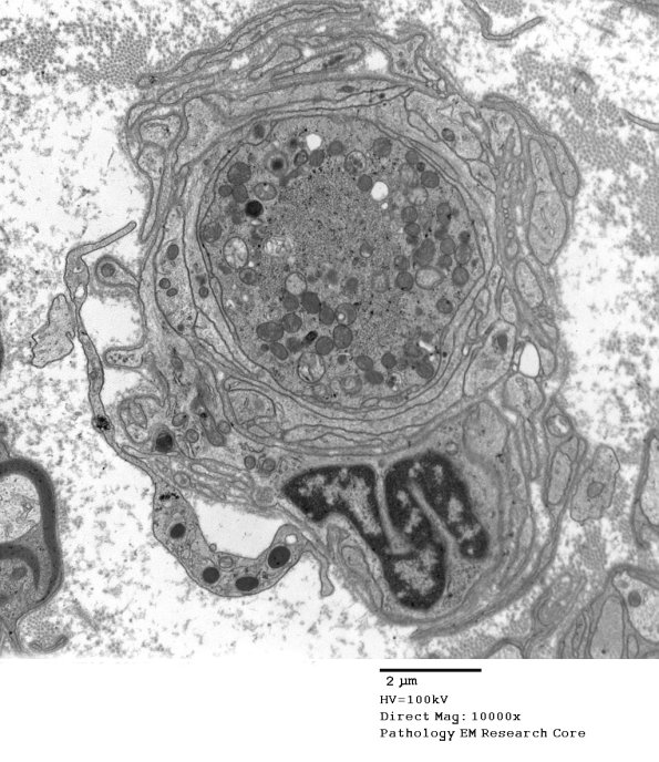 11M1 (Case 18) Nerve_186 - Copy