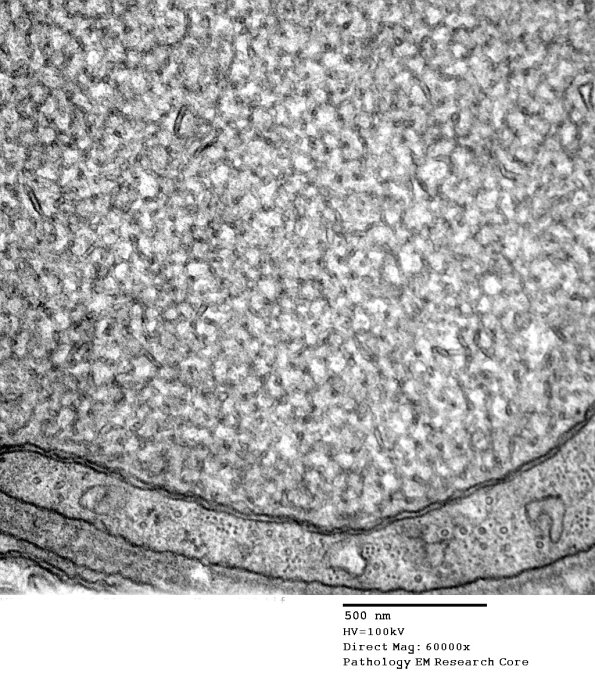 11N2 (Case 18) Nerve_192 - Copy