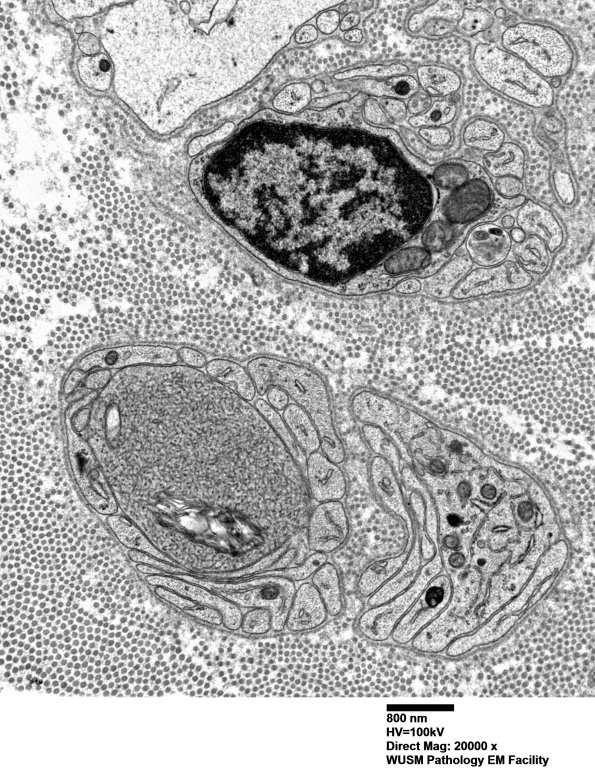 11O1 (Case 23) nerve_022 - Copy