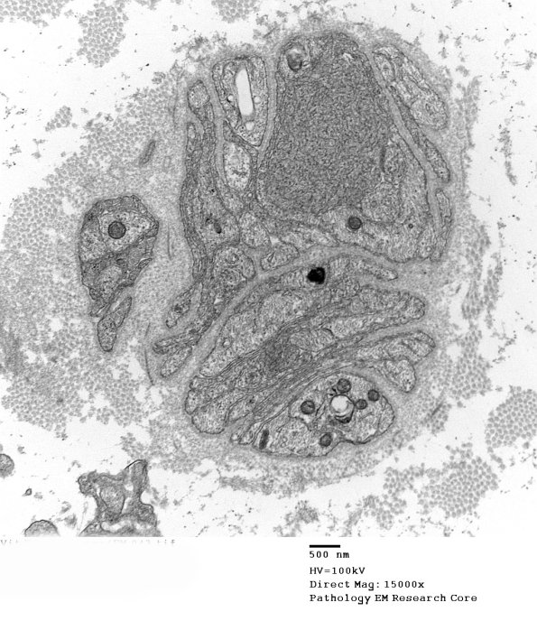 11Q1 Vit E Deficiency (EM_043 - Copy