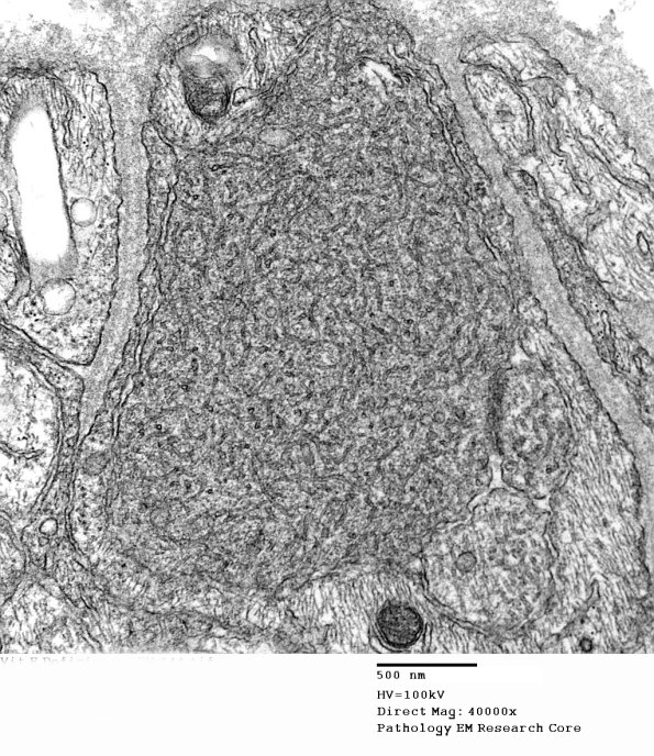 11Q2 Vit E Deficiency (EM_044 - Copy