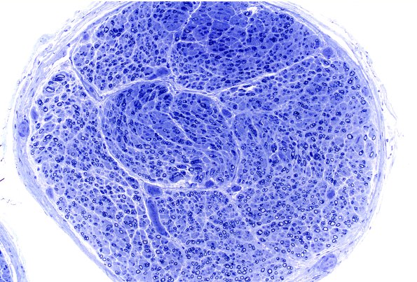 13A1 (Case 13) Plastic 20X 3