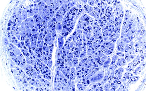 13A2 (Case 13) Plastic 40X 1