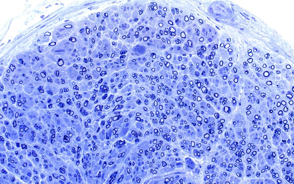 13A3 (Case 13) Plastic 40X 2