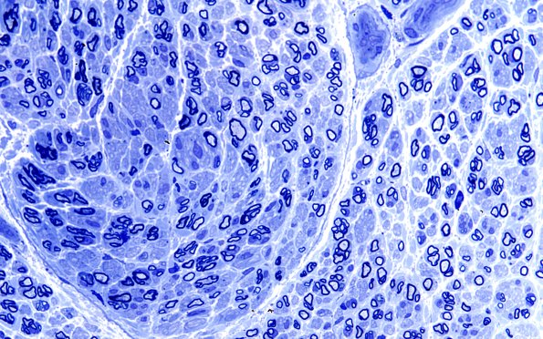 13A4 (Case 13) Plastic 60X 1