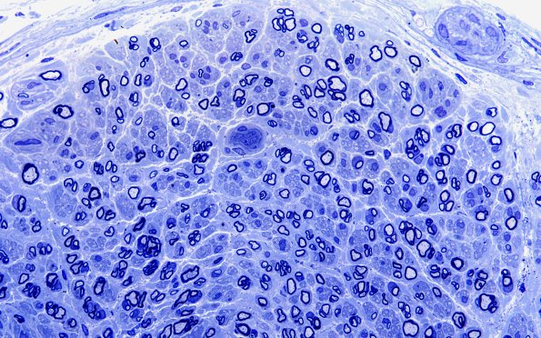 13A5 (Case 13) Plastic 60X 3