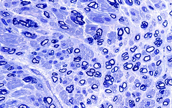 13A6 (Case 13) Plastic 100X 1