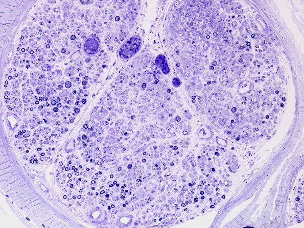 3A1 SLE (Case 1) Plastic 2.jpg