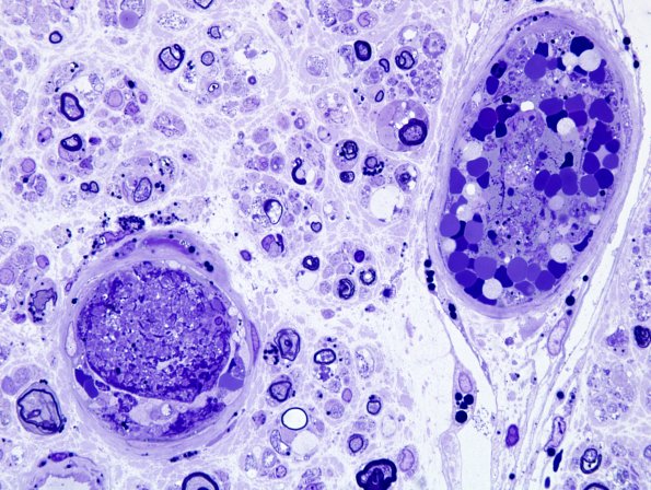3A3 SLE NP vasculitis (Case 1) 100X.jpg