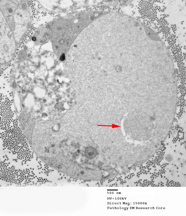 3B16A SLE NP Vasculitis (Case 1)_054 copy - Copy