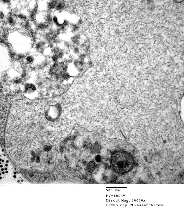 3B16B SLE NP Vasculitis (Case 1)_055 - Copy