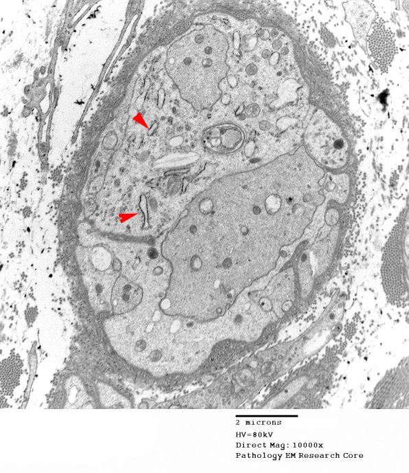 3B18 Regeneration, axonal clusters (Case 2) 028 copy - Copy