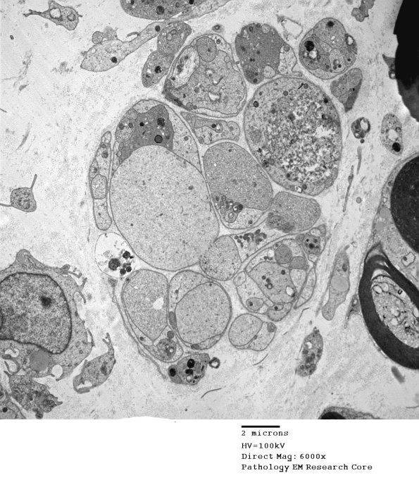 3B3 Axonal regeneration, SLE NP Vasculitis (Case 1)_003 - Copy