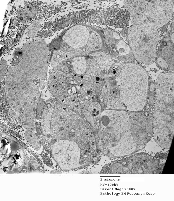 3B4 SLE NP Vasculitis (Case 1)_013 - Copy