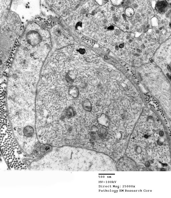 3B4A SLE NP Vasculitis (Case 1)_014 - Copy