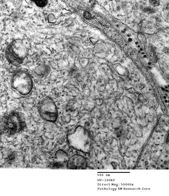 3B4B SLE NP Vasculitis (Case 1)_015 - Copy
