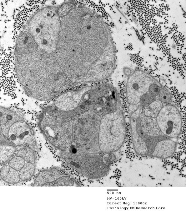 3B6A Axonal regeneration, SLE NP Vasculitis (Case 1)_058 - Copy