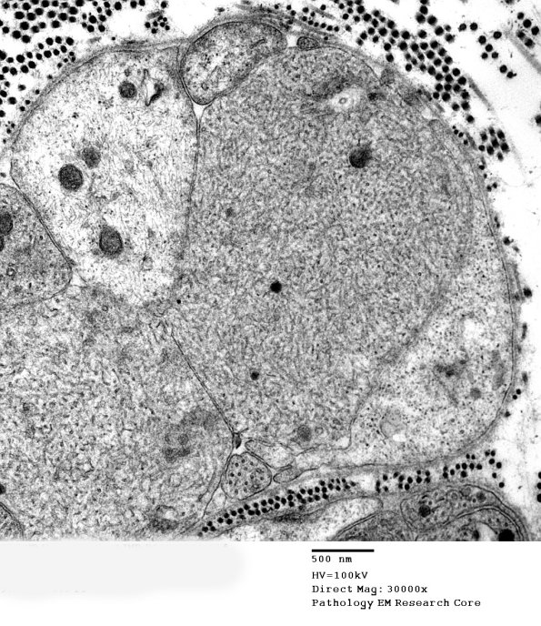 3B6B SLE NP Vasculitis (Case 1)_060 - Copy
