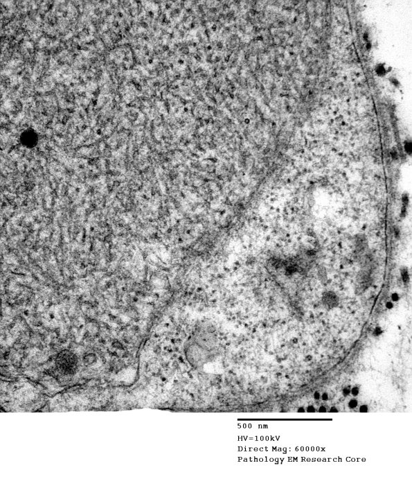 3B6C Axonal regeneration, SLE NP Vasculitis (Case 1)_061 - Copy