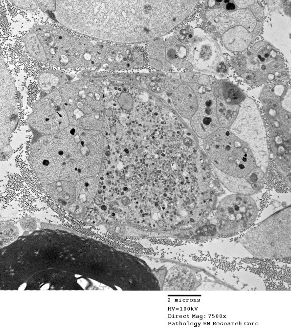 3B7 Axonal regeneration, SLE NP Vasculitis (Case 1)_018 - Copy