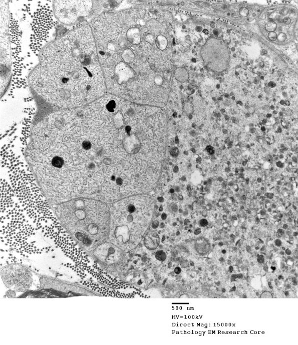 3B7A Axonal regeneration, SLE NP Vasculitis (Case 1)_042 - Copy