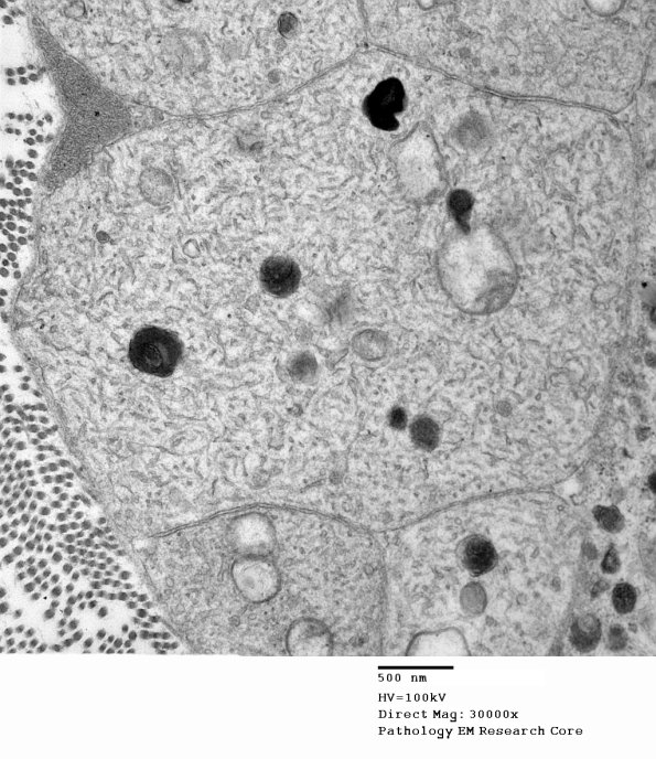 3B7B Axonal regeneration, SLE NP Vasculitis (Case 1)_048 - Copy