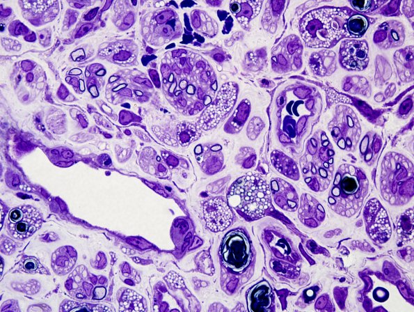 4A2 Axonal Degeneration-Regeneration Mphage rich (Case 3) Plastic 8.jpg