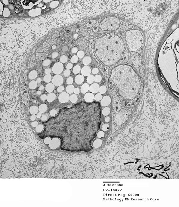 4B1 Axonal Regeneration (Case 3) EM 027 - Copy