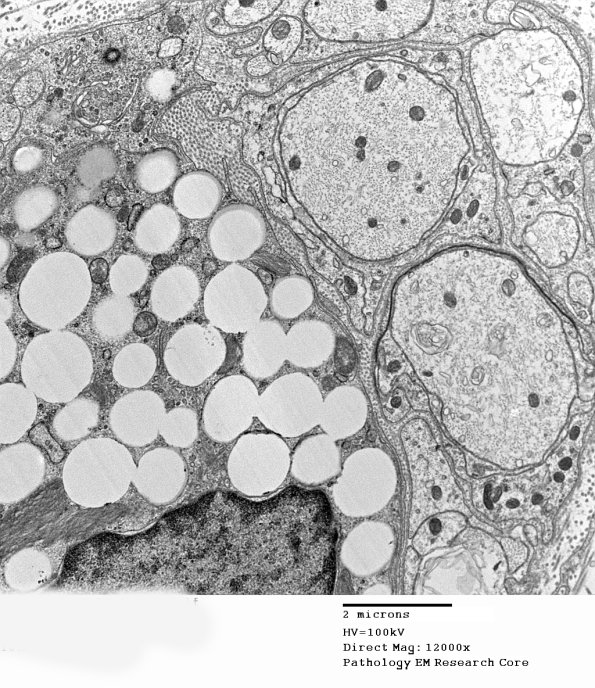 4B2 Axonal Regeneration (Case 3) EM 028 - Copy