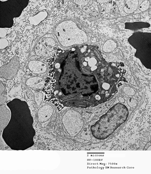 4B3 Axonal Regeneration (Case 3) EM 044 (2) - Copy