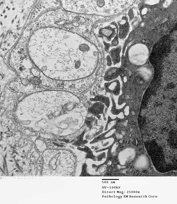4B4 Axonal Regeneration (Case 3) EM 046 - Copy