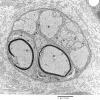 4B5 Axonal Regeneration (Case 3) EM 017 - Copy