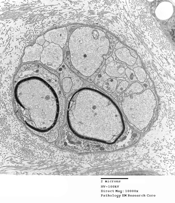 4B5 Axonal Regeneration (Case 3) EM 017 - Copy