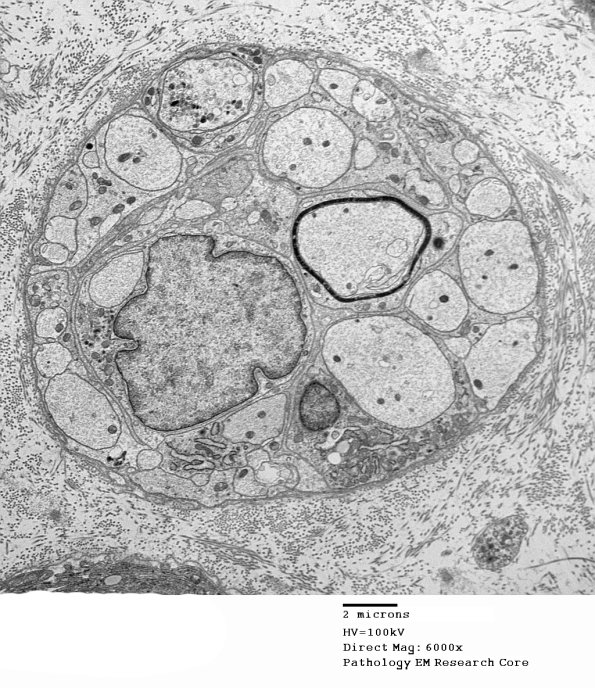 4B7 Axonal Regeneration (Case 3) EM 019 - Copy