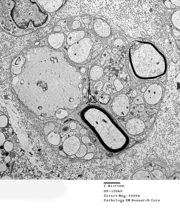 4B8 Axonal Regeneration (Case 3) EM 039 - Copy