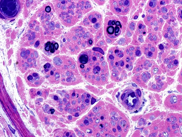 5A1 Pyronine Thionine Stain (Case 4) Plastic 10.jpg
