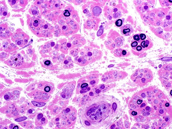 5A2 Pyronine Thionine Stain (Case 4) Plastic 18.jpg