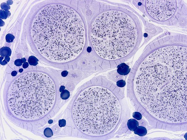 5B1 Axonal Degeneration & Regeneration (Case 5) Plastic 1