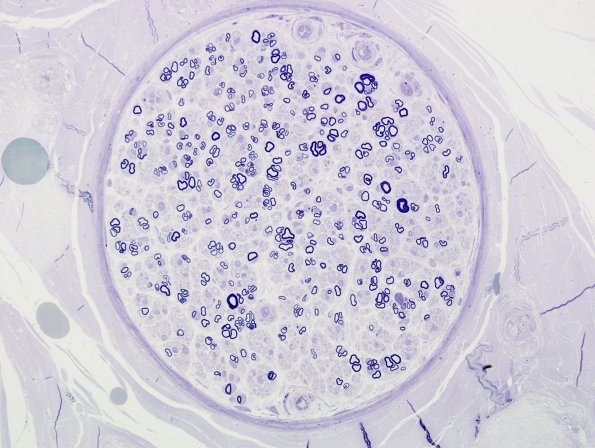 5B2 Axonal Degeneration & Regeneration (Case 5) Plastic 5 (3)
