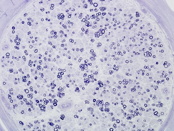5B3 Axonal Degeneration & Regeneration (Case 5) Plastic 3