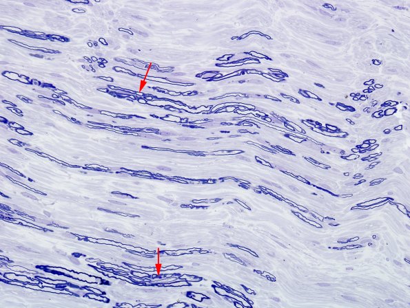 5B4 Axonal Degeneration & Regeneration (Case 5) Plastic 6 copy